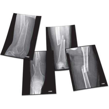 Roylco Four Fractures X-ray Sheets (R49256)